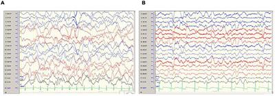 Delayed Neuropsychiatric Sequel Following Pediatric Carbon Monoxide Poisoning: A Case Report and Literature Review